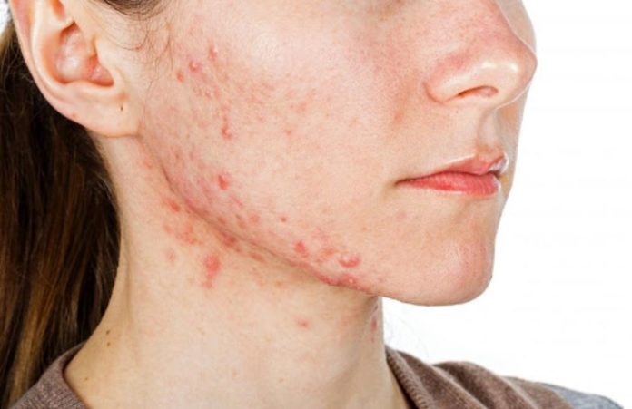 What to Do If Acne Does Not Go Away